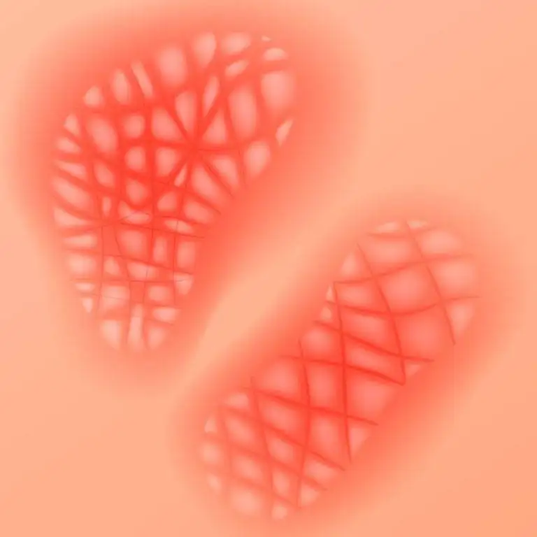 Psoriasis and Ayurvedic Treatment