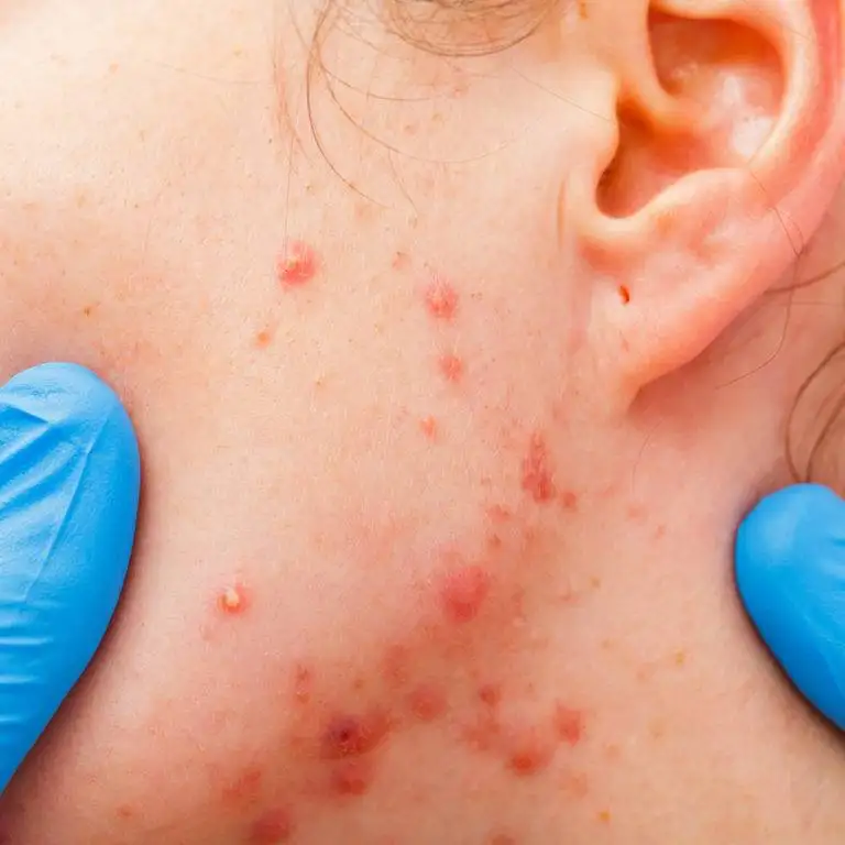 Acne Ayurvedic Treatments