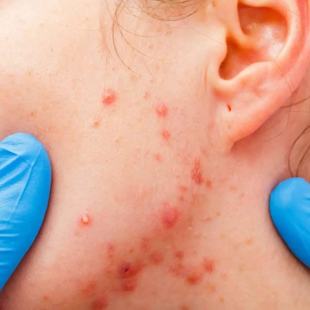 Acne Ayurvedic Treatments