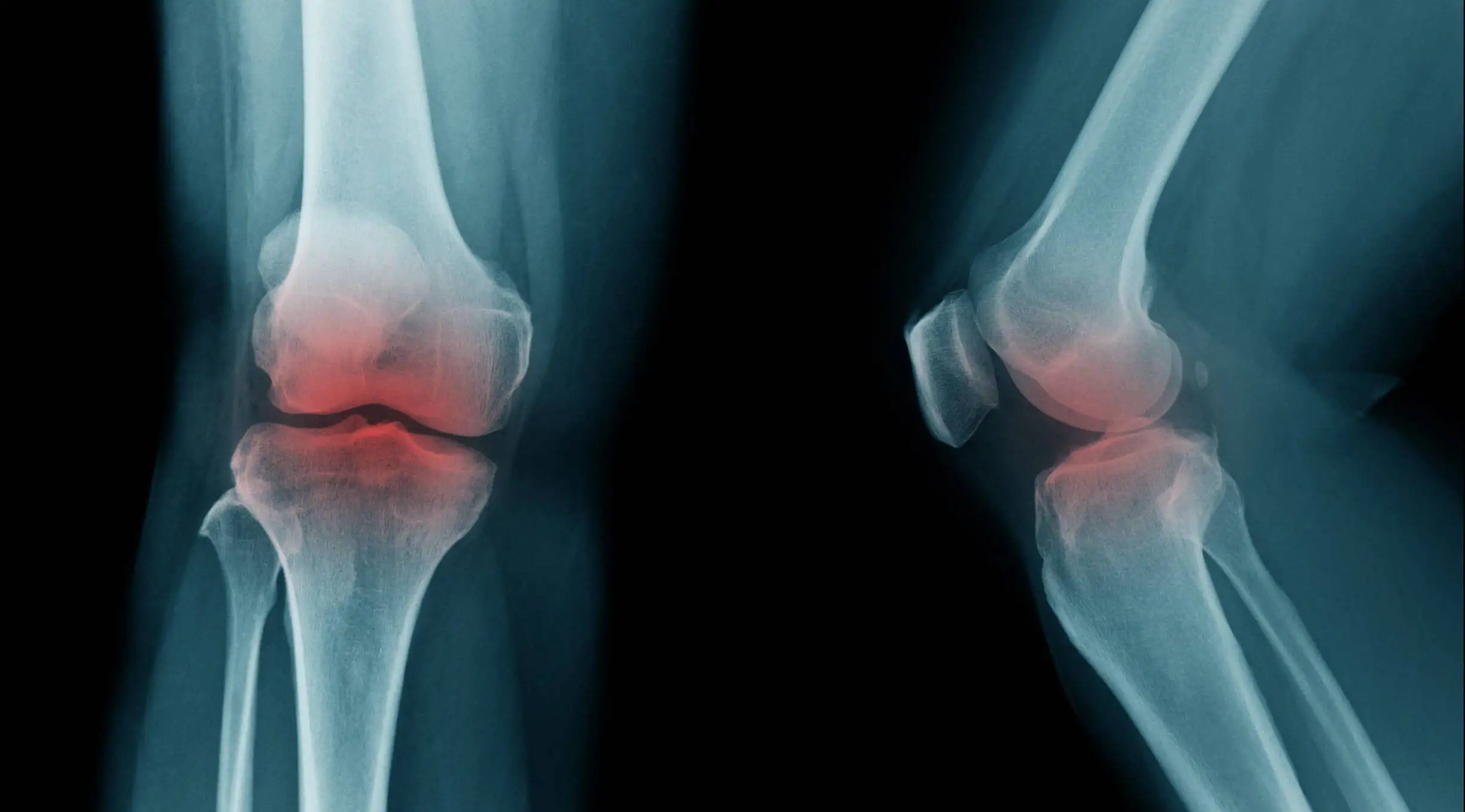 Arthritis – Osteoarthritis